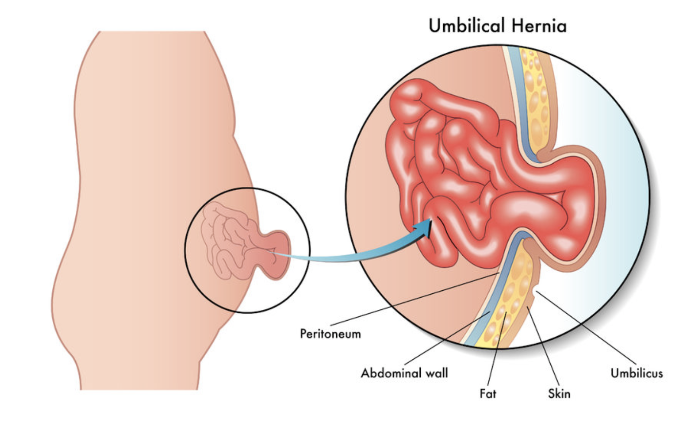 Umbilical Hernia. Occurs around the belly button, frequently seen in adults with obesity, pregnancy, or previous surgery.